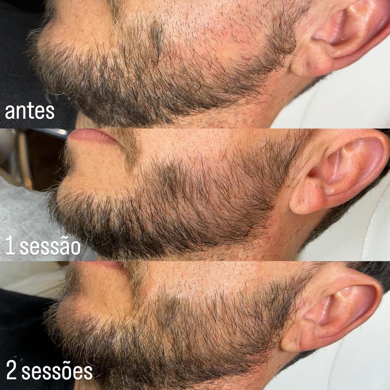 Regeneração de Barba — Antes e Depois
